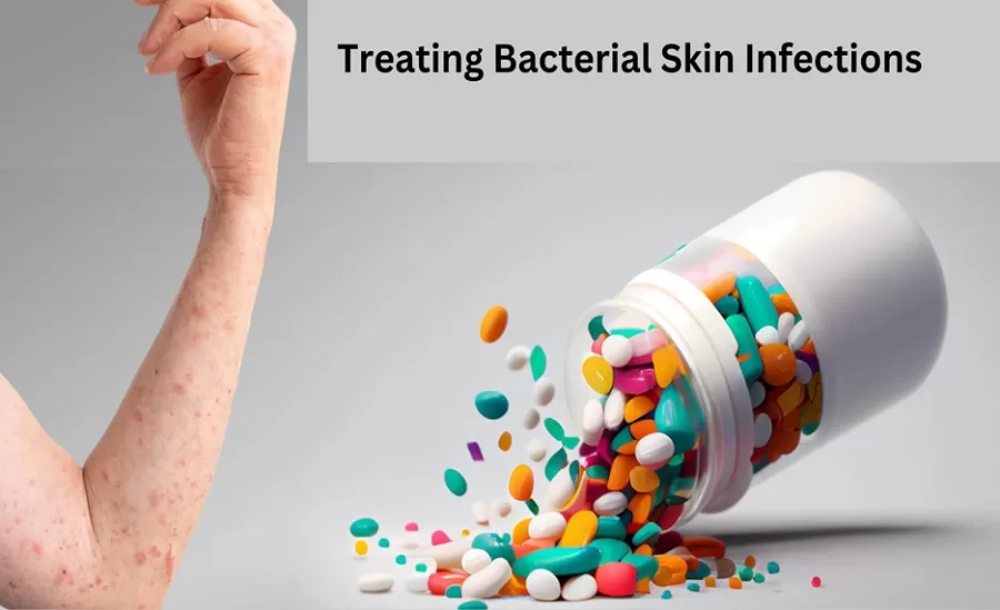 Why Antibiotics Are Essential in Treating Bacterial Skin Infections